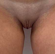 Labiaplasty Before