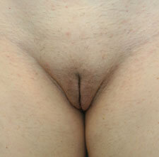 Labiaplasty After