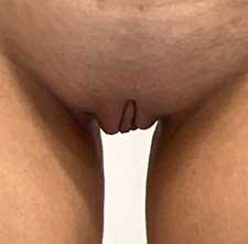 Labiaplasty After