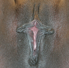Labiaplasty Before
