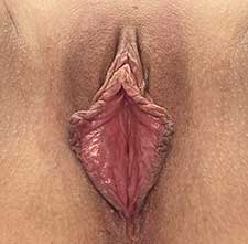 Labiaplasty Before