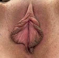 Labiaplasty Before