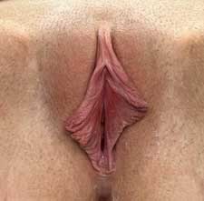 Labiaplasty Before