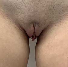 Labiaplasty Before