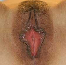 Labiaplasty Before