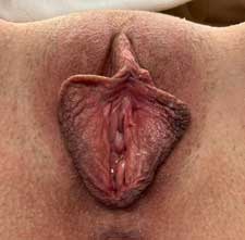 Labiaplasty Before