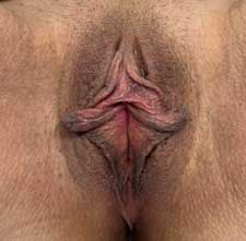 Labiaplasty Before