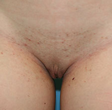 Labiaplasty After