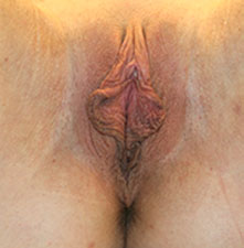 Labiaplasty Before