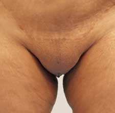 labial puff - before
