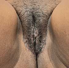 Vaginoplasty Perineoplasty After
