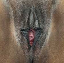 Vaginoplasty Before