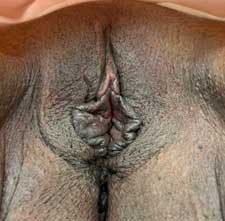 Vaginoplasty / Perineoplasty Intra