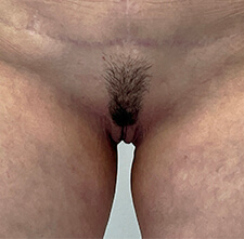 Vaginoplasty Before