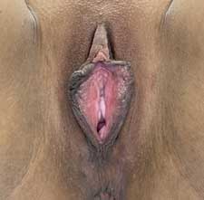 Vaginoplasty Before