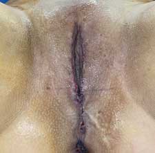 Vaginoplasty After