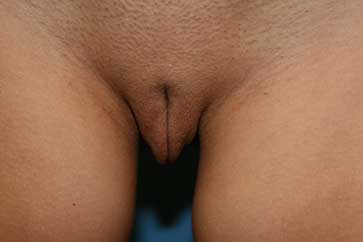 labia majora enlarged photo