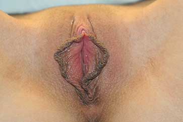 pigmented labia photo